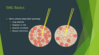 Neuropathy vs myopathy on EMG [upl. by Bernarr432]