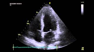 Paradoxical Motion of Interventricular Septum [upl. by Anelram]