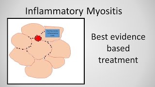 Myositis Inflammatory Myopathy Treatment [upl. by Negroj]