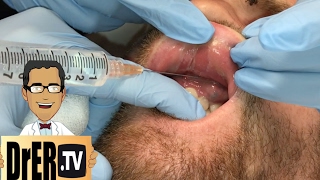 gum abscess drainage  Full VIDEO [upl. by Oraneg]