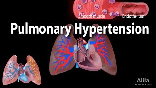 Pulmonary Hypertension Animation [upl. by Anaz430]