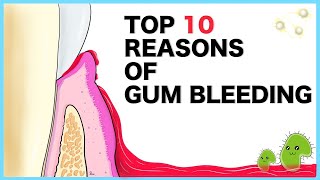 Gum Bleeding Top 10 causes [upl. by Frederick]