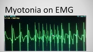 Myotonia on EMG [upl. by Heigl345]