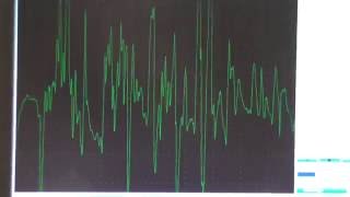 Myopathy EMG changes explained [upl. by Annadiana274]