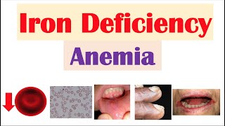 IronDeficiency Anemia Overview  Causes Pathophysiology Signs amp Symptoms Diagnosis Treatment [upl. by Nilo245]