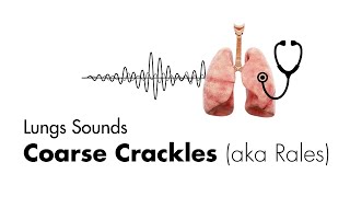 Coarse Crackles Rales  Lung Sounds  Medzcool [upl. by Ruperto]