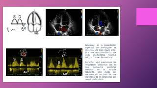 Ecocardiograma modo Doppler [upl. by Anatnas419]