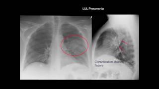 Chest Xray Cases 1 [upl. by Haissi]