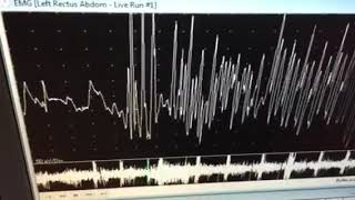 neuromyotonic discharges [upl. by Rabjohn]