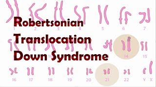 Robertsonian Translocation Down Syndrome ROB [upl. by Nhguavaj]