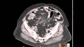 CT Sigmoid Diverticulitis DISCUSSION [upl. by Retsevlis]